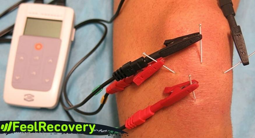 Quelles sont les différences entre l'électrostimulation TENS et l'électrostimulation PENS ?