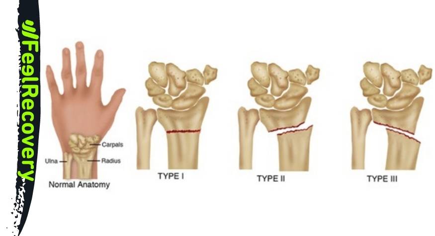 What types of hand bone fractures are there?