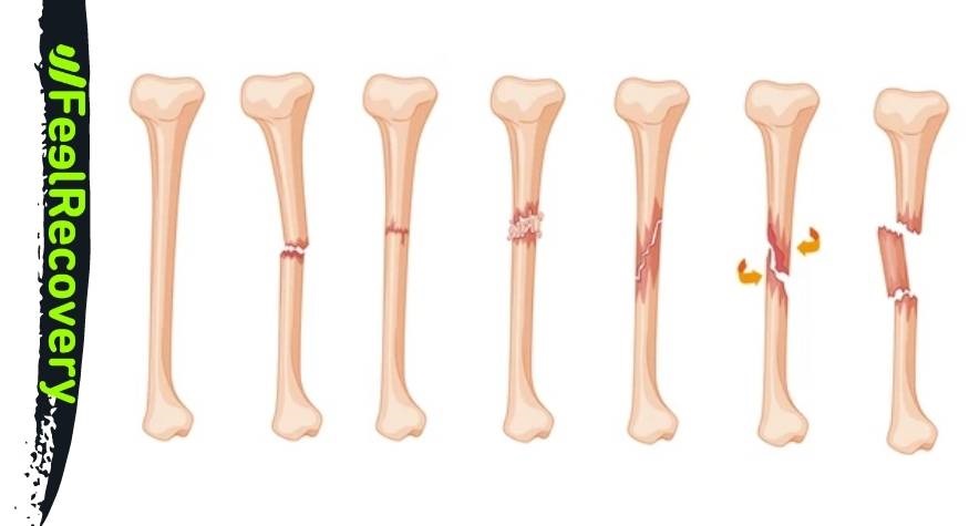 What types of leg bone fractures are there?