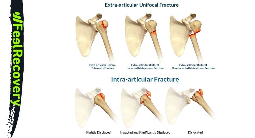 What are the types of shoulder bone fractures there are?