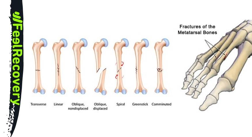 ¿Cuáles son los tipos de fracturas de los huesos del pie que hay?