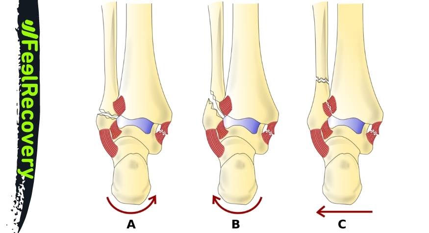 What types of ankle bone fractures are there?