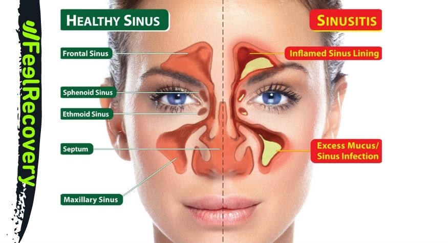 What is sinusitis or sinus pain and how to identify it?