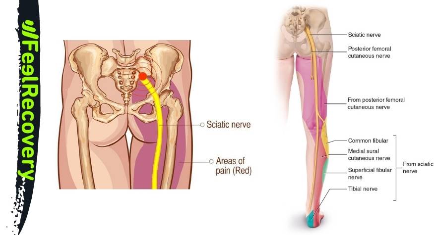 Definition: What is sciatica or inflammation of the sciatic nerve?