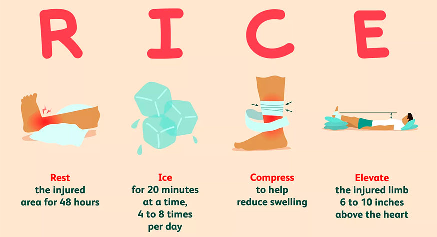 Infographics RICE therapy