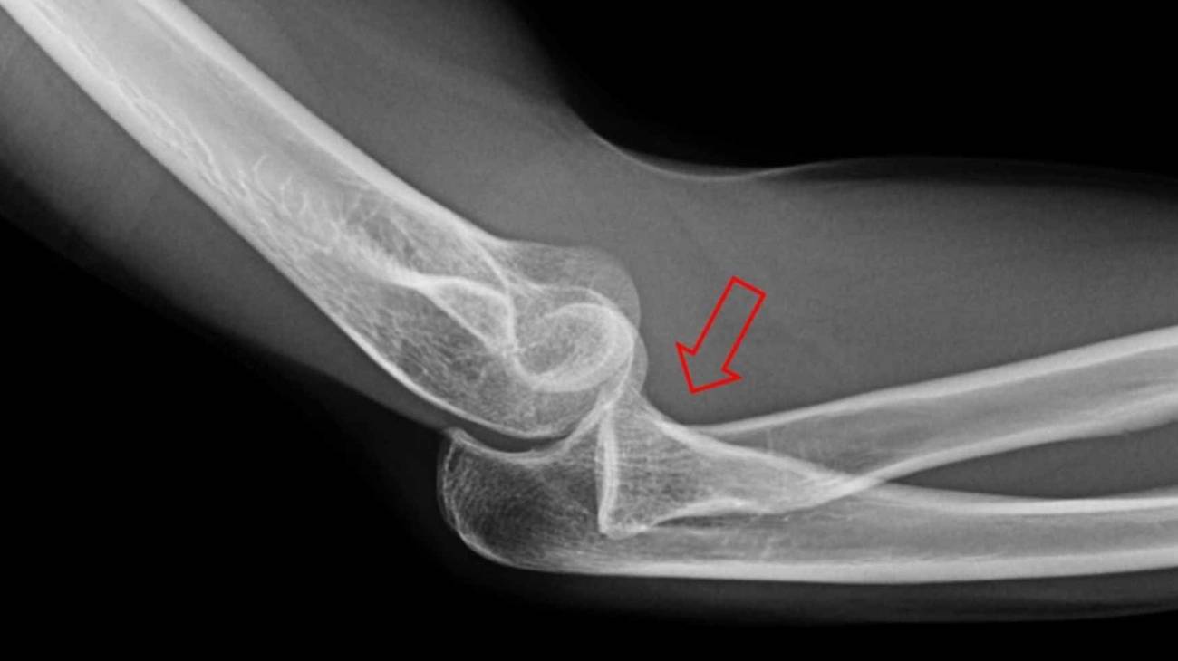 Elbow dislocation