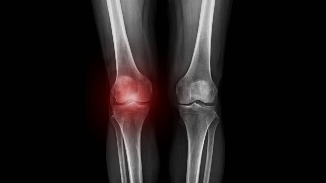 Knee dislocation