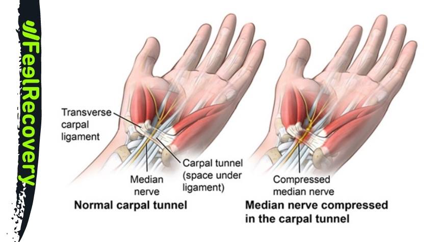 Definition: What is carpal tunnel syndrome?