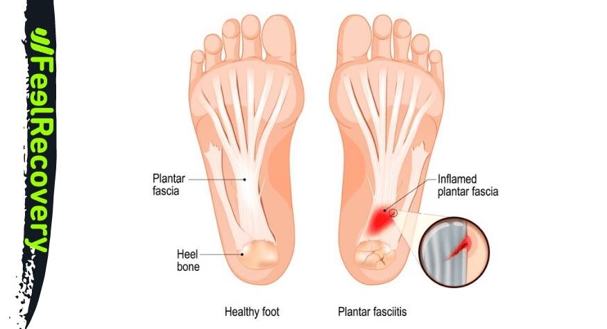 Masajes para 2025 la fascitis plantar