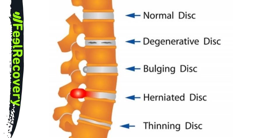 Definición: ¿Qué es la hernia discal lumbar o cervical?