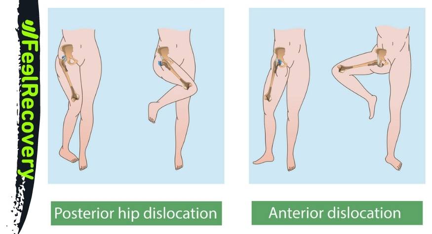 ¿Qué es la luxación de la articulación de cadera?