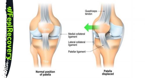 KNEECAP DISLOCATION > Causes > Symptoms > First Aid | Feel RecoveryÂ®