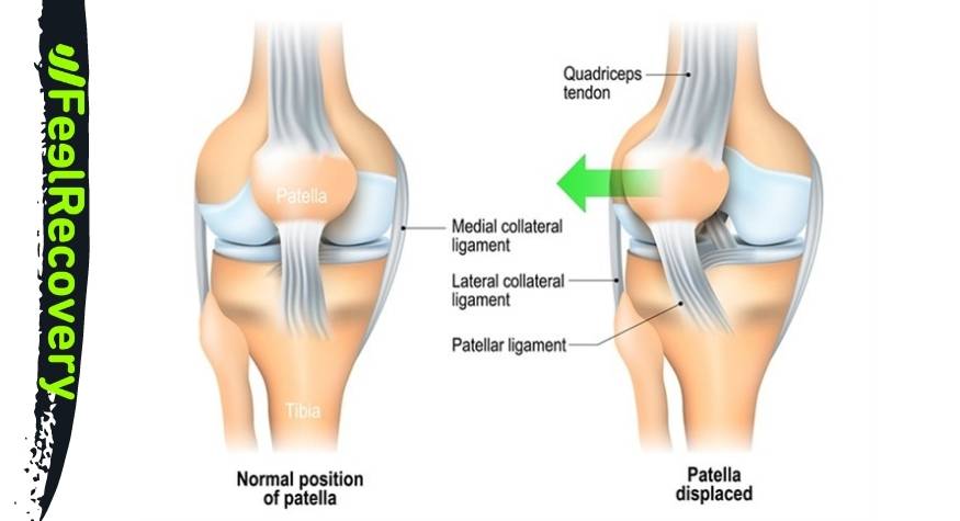 What is dislocation of the patella joint?