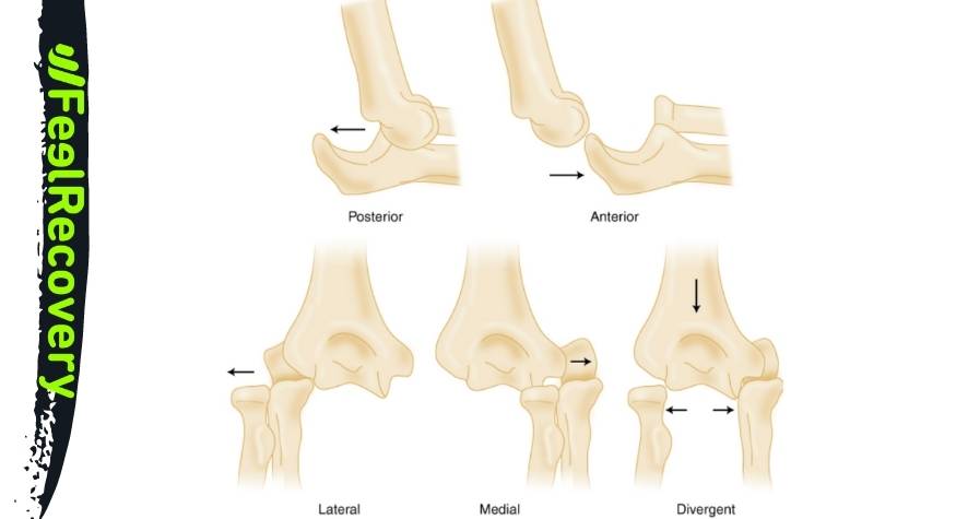 What is elbow joint dislocation?