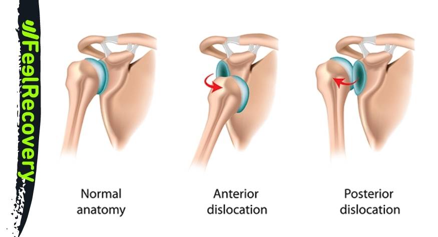 What is dislocation of the shoulder joint?