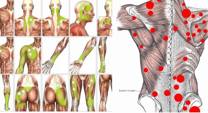 What are trigger points and why do they appear in myofascial tissue?