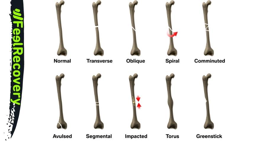 Quels sont les types de fractures les plus courants ?