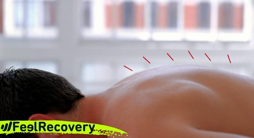 acupuncture and dry needling