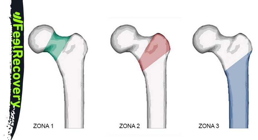 What are the types of hip fractures?